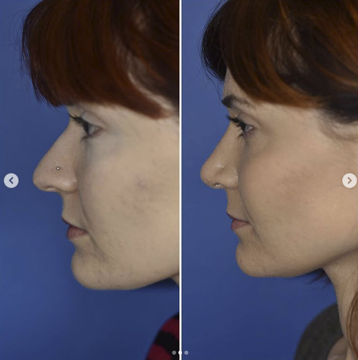 nose tip surgery